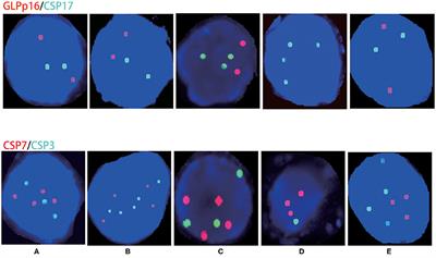 Evaluation of UroVysion for Urachal Carcinoma Detection